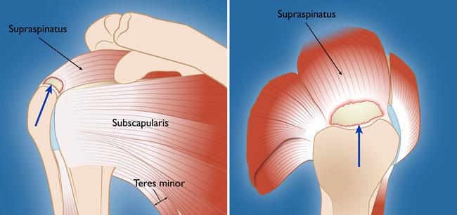 partially torn rotator cuff treatment