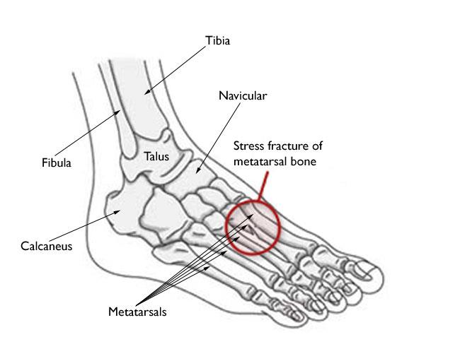 Stress hot sale fracture heel