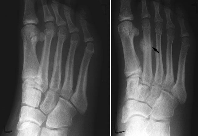 second metatarsal fracture