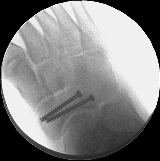 screw fixation of navicular stress fracture