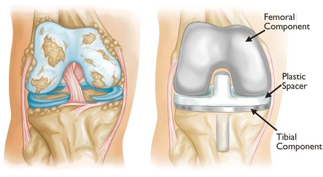 I have a total 2025 knee replacement gum infection