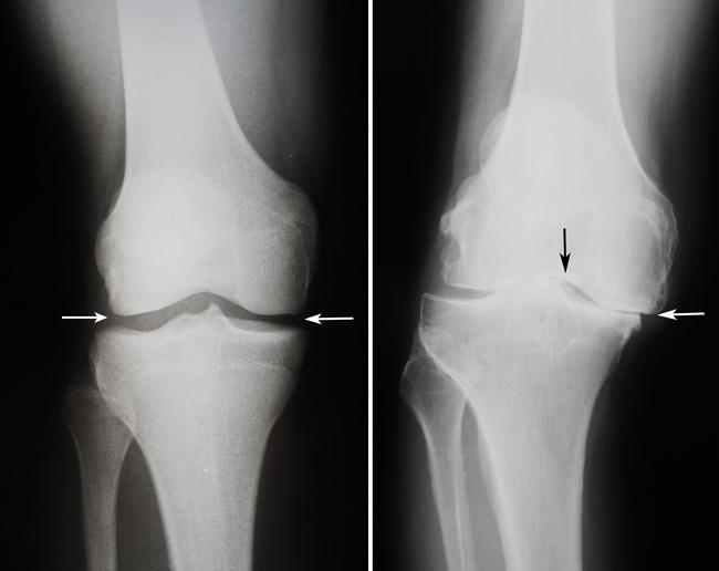 What Does An X Ray Show Of The Knee at Anna Killinger blog