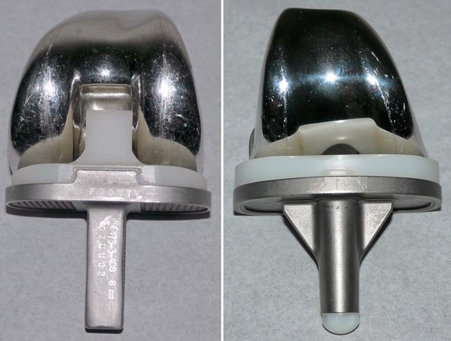 Different types of knee implants 