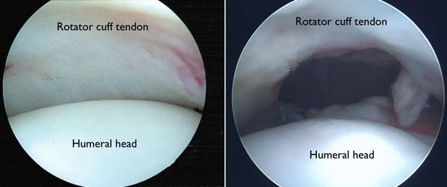 Arthroscopic photos of healthy shoulder joint and rotator cuff tear