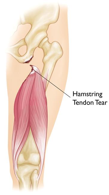 A severe hamstring injury where the tendon has been torn from the bone. 