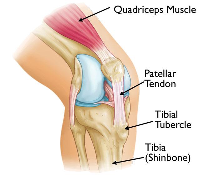 Osgood-Schlatter disease causes pain at the tibial tubercle — the bony bump where the patellar tendon attaches to the tibia (shinbone). 