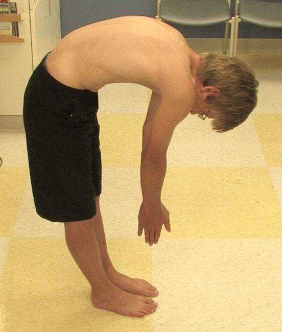 Foto clínica de la prueba de flexión hacia adelante de Adam
