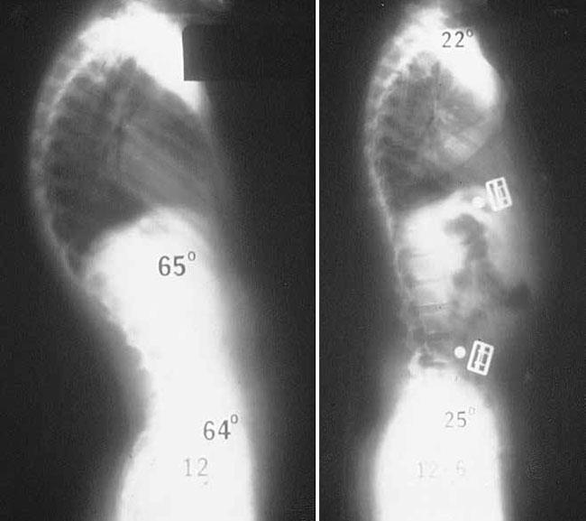 X-rays of a kyphotic spinal curve before and after bracing