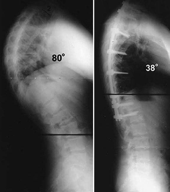 Radiografías de una curva cifótica antes y después de la fusión espinal