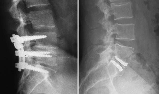 X-rays of lumbar spinal fusion and disk replacement
