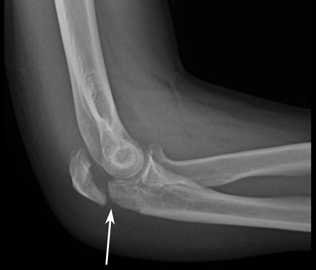 X Ray Of Displaced Olecranon Fracture