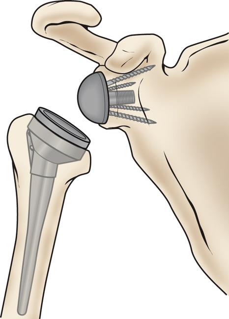 Reverse Total Shoulder Replacement OrthoInfo AAOS