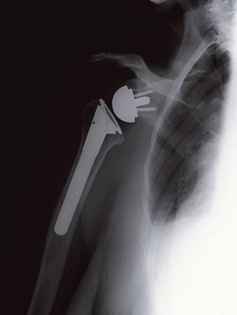 Radiografía que muestra el reemplazo total de hombro inverso