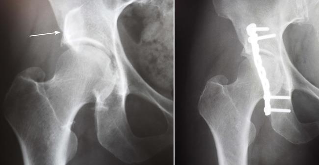 X-rays of an acetabular fracture before and after internal fixation