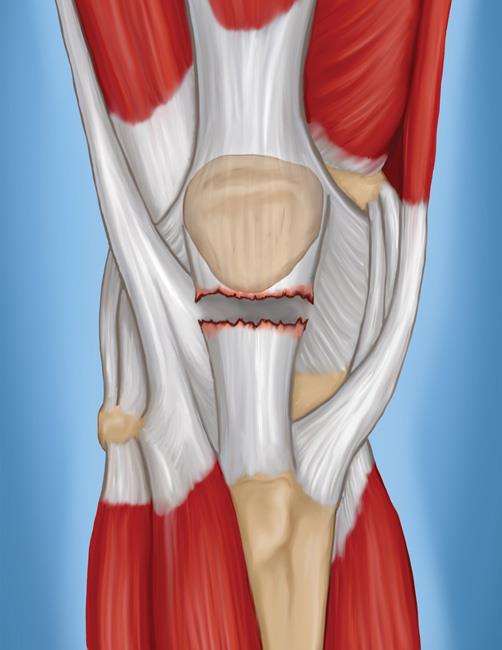 Patella Tendon Injury Treatment