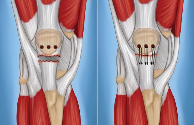 surgery for patellar tendon tear