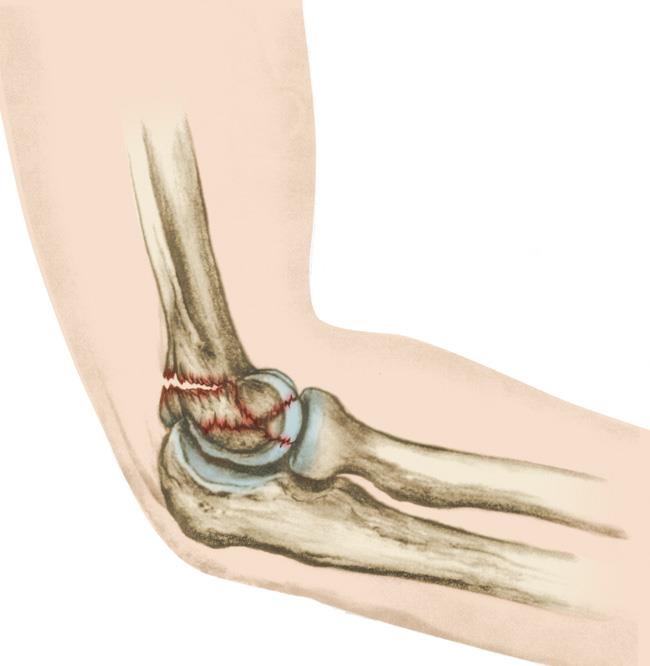 A comminuted distal humerus fracture