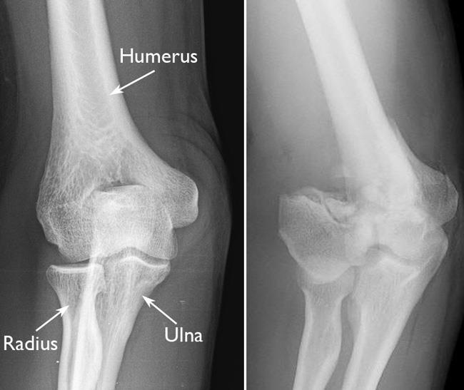 Radiografías de un codo normal y una fractura de codo desplazada