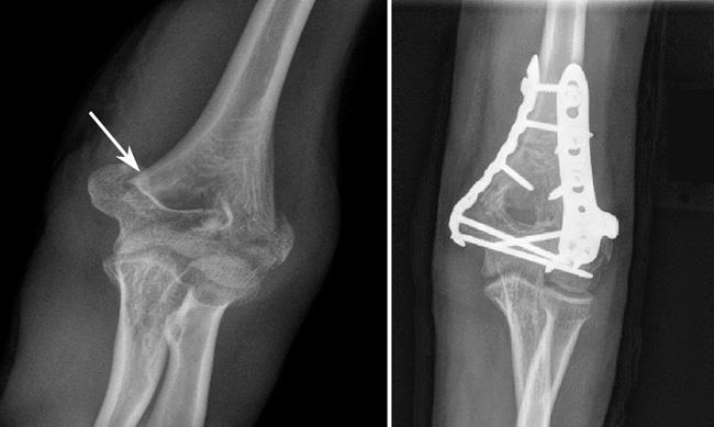 Radiografías de una fractura de húmero distal antes y después de la fijación interna