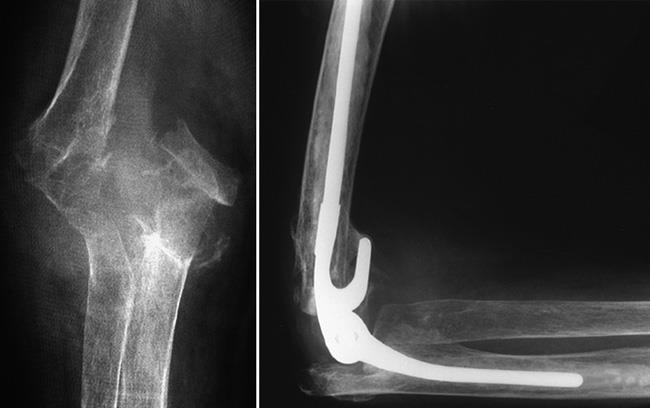 A distal humerus fracture treated with elbow joint replacement 