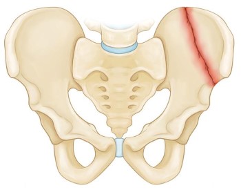 Cracked pelvis treatment and recuperation pictures