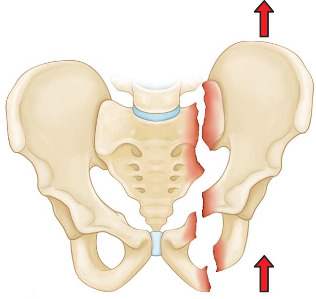 Illustration of vertical shear fracture