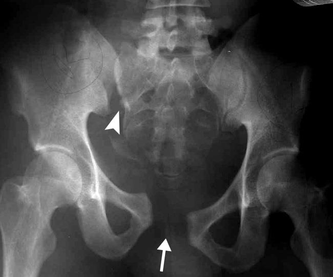 X-ray of an unstable pelvic fracture