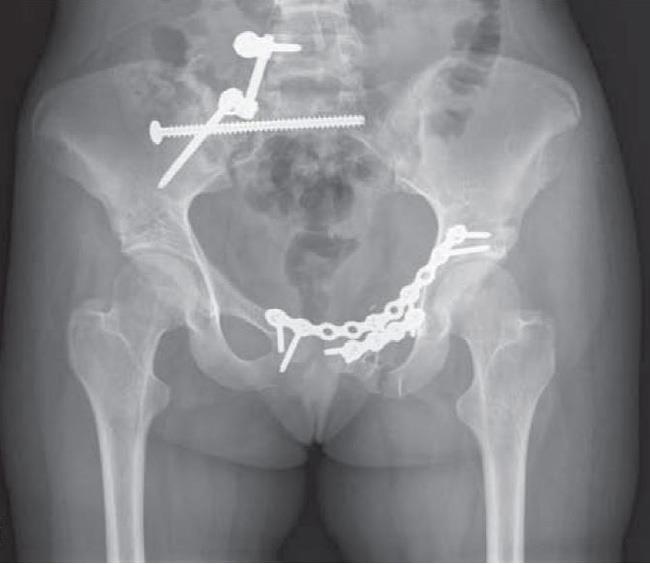 superior pubic ramus fracture