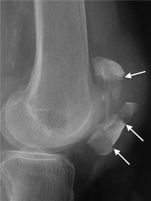 knee cap xray