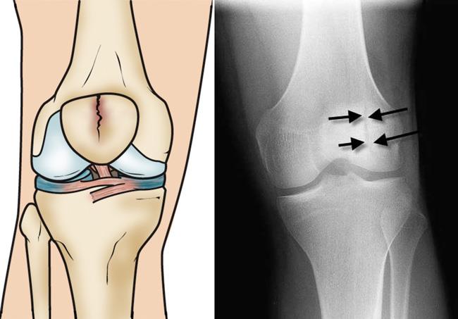 Illustration and x-ray show a vertical, stable fracture of the patella. 