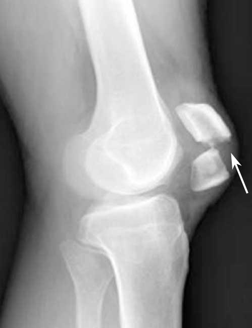 broken kneecap symptoms