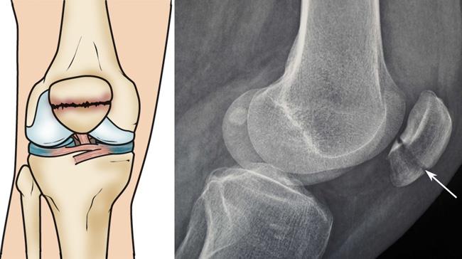 how to tell if your kneecap is broken