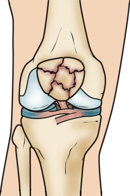 kneecap pain after fall