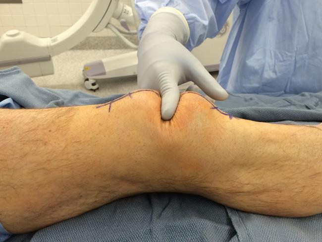 patellar fracture with significant displacement