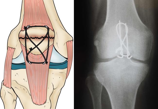 kneecap fracture surgery