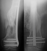 Internal fixation of distal femur fractures