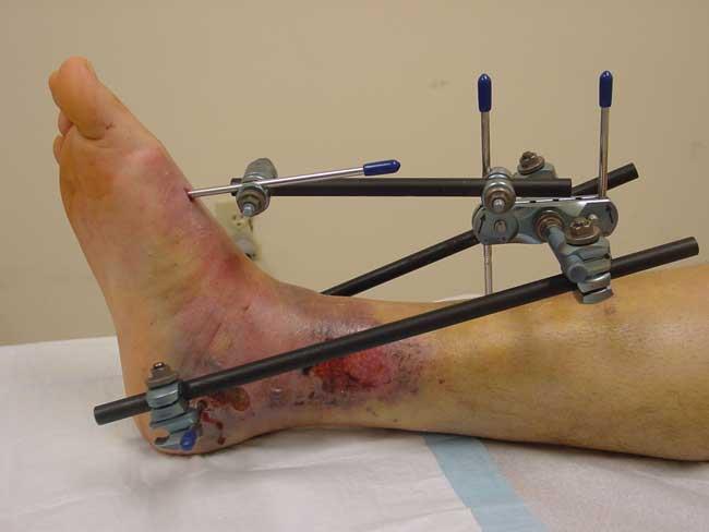 orif tib fib fracture hardware