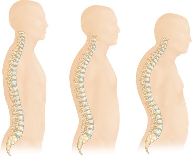 Changes in the spine from the progression of osteoporosis