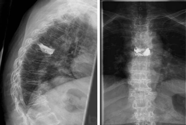 Side and front view of spine after kyphoplasty