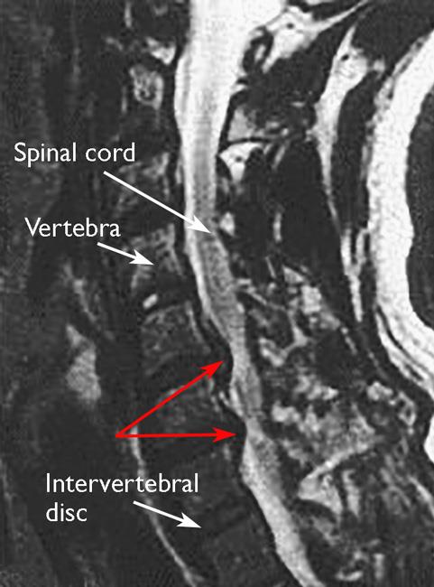 MRI scan of a herniated disk