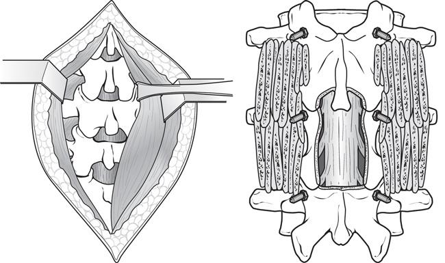 Cervical Spondylotic Myelopathysurgical Treatment Options Orthoinfo Aaos 1961