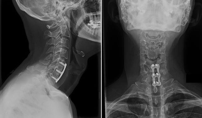 Triumferende chance social Cervical Radiculopathy: Surgical Treatment Options - OrthoInfo - AAOS