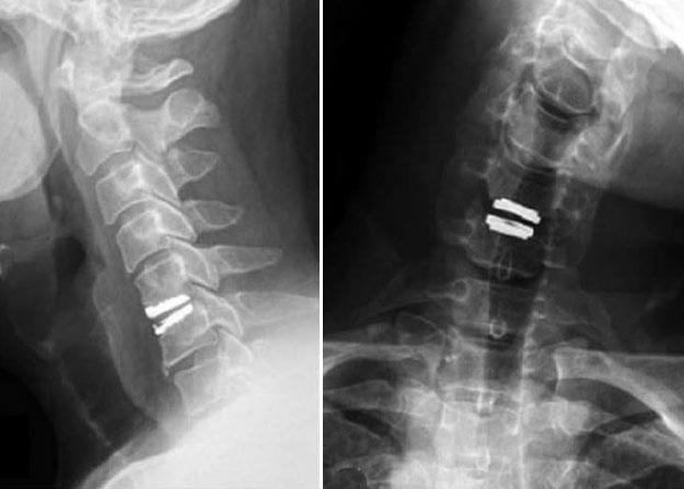 X-rays showing artificial disk replacement in the cervical spine