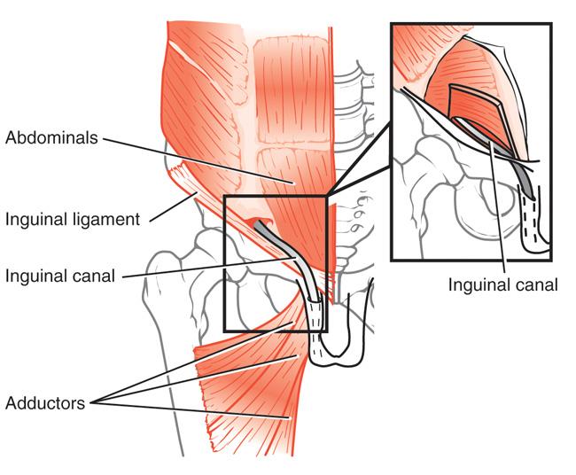 Sports Hernia Athletic Pubalgia Orthoinfo Aaos