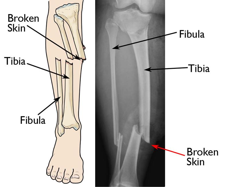 Illustration and x-ray show an open fracture