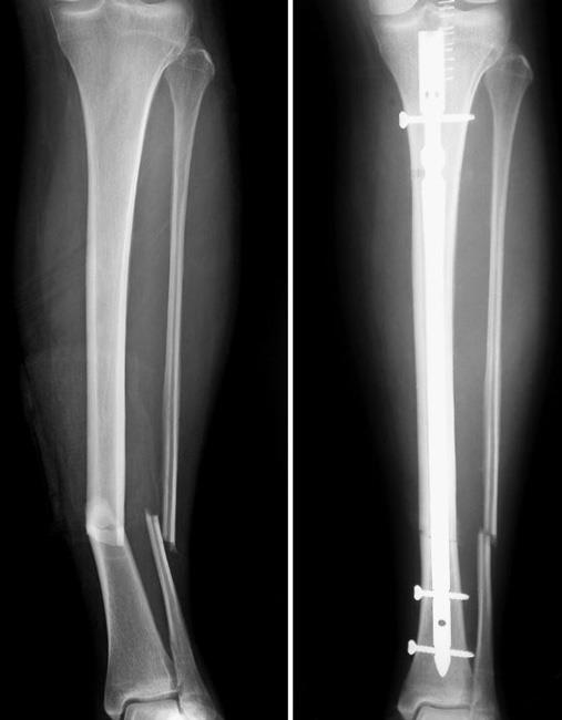 human broken leg x ray