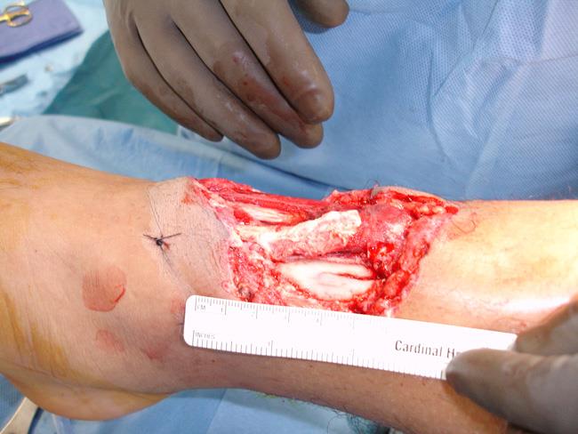 open fracture that cannot be closed with stitches