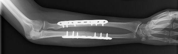 forearm fracture fixation with plates and screws