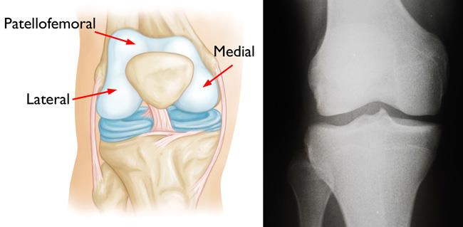 illustration of knee compartments; x-ray of a normal knee