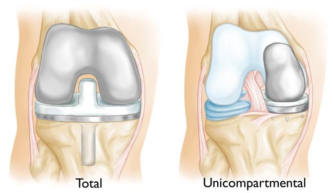 illustrations of total knee replacement and unicompartmental knee replacement
